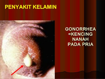 OBAT ALAMI PENIS KENCING KELUAR NANAH PADA PRIA DI APOTIK