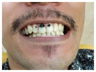 foto, gambar, gigi depan hitam Permata Dental Bali| sebelum dan sesudah gigi hitam diperbaiki di Permata Dental Bali | foto gigi keropos hitam Permata Dental Bali |gigi hitam karena sakit | gigi hitam berlubang di Permata Dental Bali | gigi hitam depan di Permata Dental Bali | gigi hitam bagian belakang | foto gigi hitam yang sudah diperbaiki Permata Dental Bali |  gigi hitam bagian depan| foto gigi keropos dan hitam, foto gigi hitam oleh Permata Dental Bali , Bali Hits, Bali banget, area Bali, Bali  kota, area kampus Bali. veneer gigi hitam Bali | gambar sebelum dan sesudah veneer gigi hitam dan berlubang  veneer gigi hitam Bali | veneer gigi hitam denpasar| veneer gigi hitam nusadua | veneer gigi hitam ngurahrai| veneer gigi hitam badung| veneer gigi hitam jember jimbaran| veneer gigi hitam gatsu| veneer gigi hitam bali | veneer gigi hitam bagus di Permata Dental Bali | veneer gigi hitam baik di Permata Dental Bali | veneer gigi hitam cepat di Permata Dental Bali | veneer gigi hitam murah di Permata Dental Bali | veneer gigi hitam aman di Permata Dental Bali | veneer gigi hitam mudah di Permata Dental Bali | veneer gigi hitam promo Permata Dental Bali | gambar veneer gigi hitam Permata Dental Bali | gambar sebelum dan sesudah veneer gigi hitam dan berlubang Permata Dental Bali | veneer gigi hitam bagus | veneer gigi hitam baik | veneer gigi hitam cepat | veneer gigi hitam murah| veneer gigi hitam aman | veneer gigi hitam mudah  | veneer gigi hitam promo | gambar veneer gigi hitam | gambar sebelum dan sesudah veneer gigi hitam dan berlubang Permata Dental Bali | foto veneer gigi hitam Permata Dental Bali |perbaiki gigi hitam Permata Dental Bali | cara mengatasi gigi hitam Permata Dental Bali | menghilangkan gigi hitam Permata Dental Bali | cara menghilangkan gigi hitam Permata Dental Bali | cara memutihkan  gigi hitam Permata Dental Bali | membantu menghilangkan gigi hitam Permata Dental Bali | perbaiki Permata Dental Bali | harga perbaiki gigi hitam Permata Dental Bali | perbaiki gigi hitam murah  Permata Dental Bali | perbaiki gigi hitam promo Permata Dental Bali | perbaiki gigi hitam bagus Permata Dental Bali | perbaiki gigi hitam  aman Permata Dental Bali | perbaiki gigi hitam cepat  Permata Dental Bali | perbaiki gigi hitam mudah Permata Dental Bali | harga perbaiki gigi hitam mudah Permata Dental Bali | perbaiki gigi hitam Permata Dental Bali |proses perbaiki gigi hitam mudah Permata Dental Bali | foto perbaiki gigi hitam Permata Dental Bali | gambar perbaiki gigi hitam Permata Dental Bali | perbaiki gigi hitam mudah Permata Dental Bali | perbaiki  gigi hitam bali| perbaiki  gigi hitam denpasar  | perbaiki  gigi hitam nusadua| perbaiki  gigi hitam badung| perbaiki  gigi hitam ngurahrai| perbaiki  gigi hitam gatsu| perbaiki  gigi hitam jimbaran| perbaiki  gigi hitam tabanan| perbaiki  gigi hitam