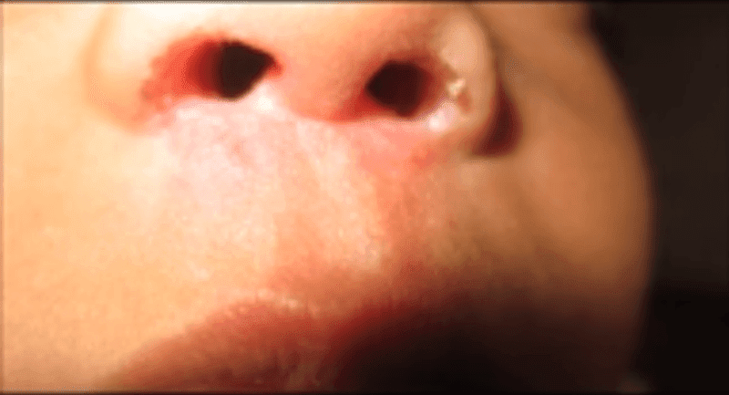 Nasal Vestibulitis Causes Symptoms Complications And Treatment