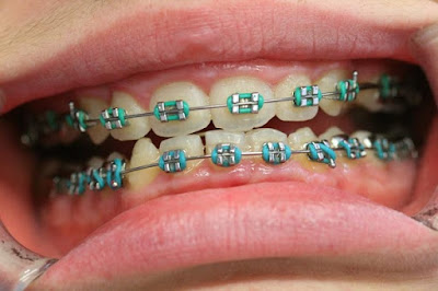 Quy trình niềng răng người lớn
