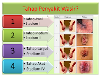 Cara Mengobati Darah Keluar Saat Buang Air Besar Langsung Sembuh