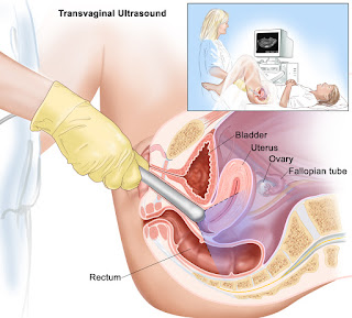 Polycystic Ovary Syndrome Surgery,polycystic ovary syndrome,polycystic ovary treatment