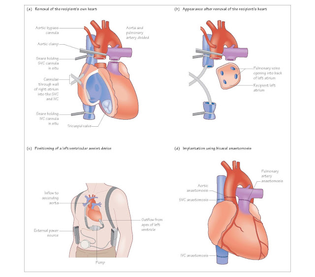 Heart Transplantation: The Operation, Transplanting the heart