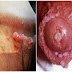 Obat Kutil Jengger Ayam thumbnail