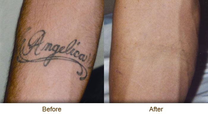 Natural Tattoo Removal: Natural Tattoo Removal Price