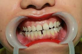 Bảo tồn răng cửa bị chấn thương như thế nào?