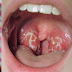 Cómo deshacerse de la infección de garganta de forma natural en solo cuatro horas