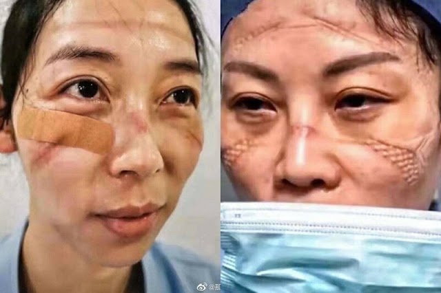 SAFETY FIRST! - Chinese Doctors At Coronavirus Quarantine Zone Have Bruises And Scars For Wearing Face Masks At The End Of Shift
