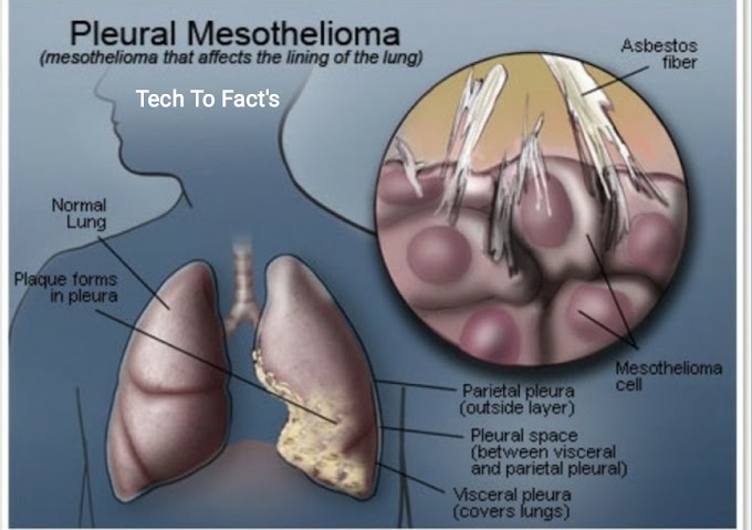 What is Pleural Mesothelioma?