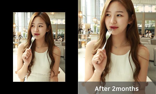 짱이뻐! - Never Regret Doing Korean Two Jaw Surgery