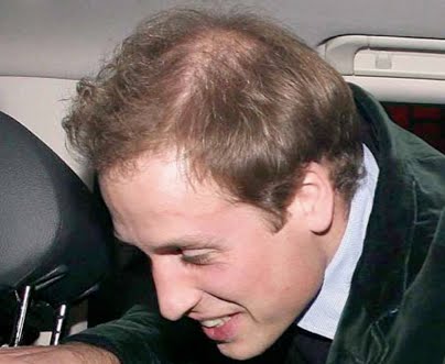 prince william balding 2010. Prince William is in town