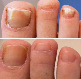 Nail fungus Treatment Zetaclear