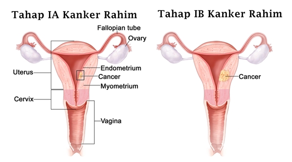 Cara Mengobati Kanker Rahim Paling Ampuh