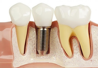 Trồng răng implant trong bao lâu?
