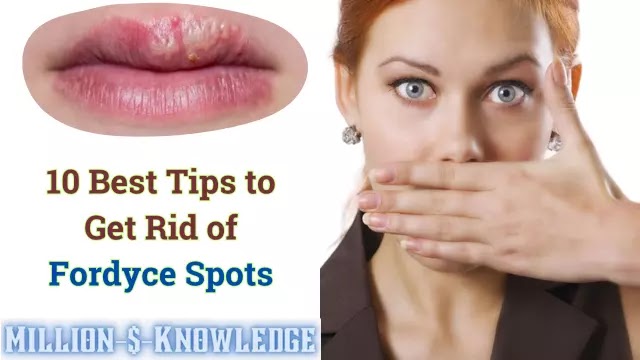 How To Get Rid Of Fordyce Spots Million Knowledge