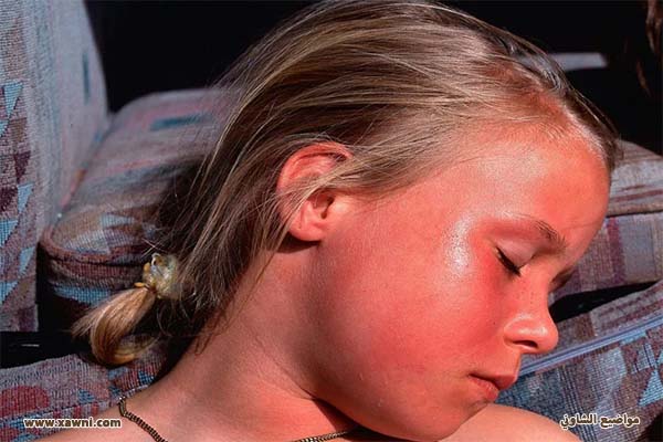علاج حروق الشمس عند الأطفال