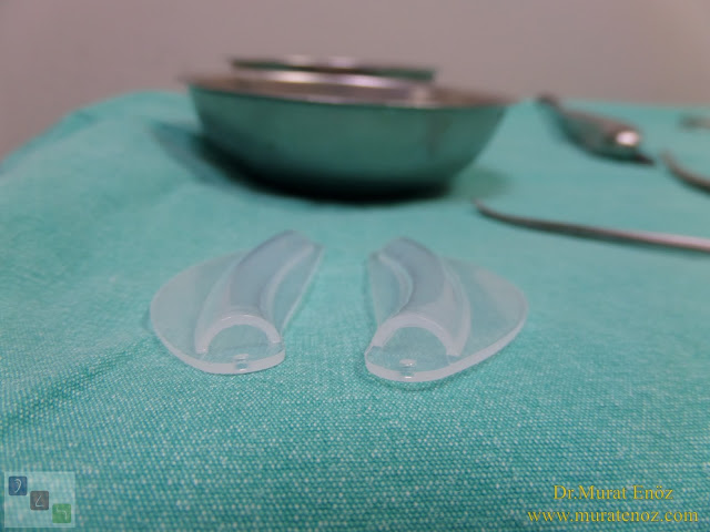 Which patients are ideal for nose operations using absorbable nasal packing? - Can all nose surgery be performed without using nasal packing? - Which patients are not suitable for nasal packing free nose surgery? - Absorbable nasal packings may not always be an alternative to normal packings! - The importance of nasal packing in turbinate radiofrequency - Which is the best nasal packing? - Nasal adhesions