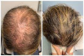 Lifestyle Changes To Maximize The Effectiveness Of Hair Growth Treatment