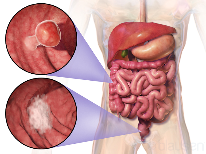 What you must know about colorectal cancer prevention