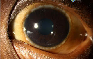 Short cases in ophthalmology