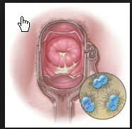 pengobatan kencing nanah dengan antibiotik  