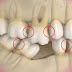 Cấy ghép răng implant