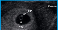 متى يبان الجنين في كيس الحمل وما هو الحمل اللاجنيني