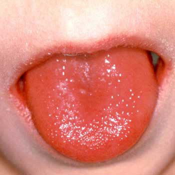 ulcers on tongue. sores on tongue appearance