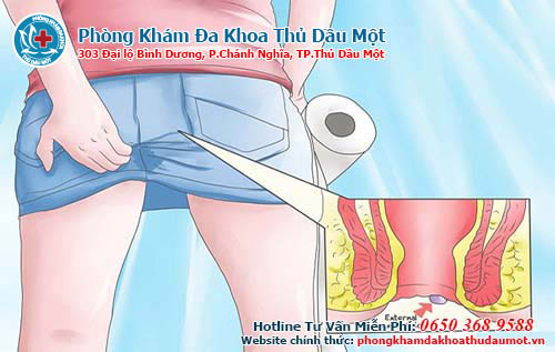  Làm thế nào để hết bệnh trĩ ngoại?