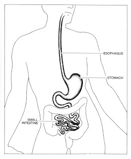 mini bypass gastrico