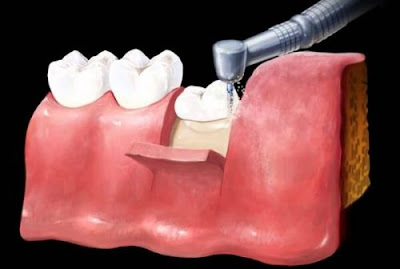 Nhổ răng thực hiện như thế nào?