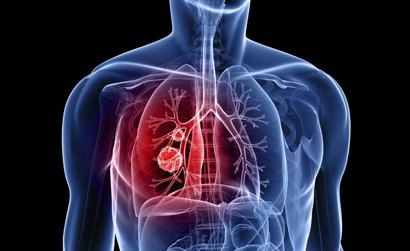 Lung cancer prevention