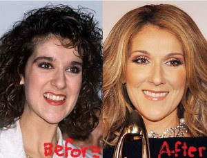 Celine Dion Nose Jobs Before and After