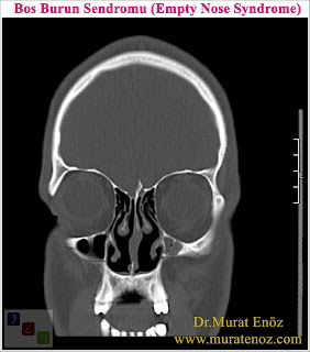 Boş Burun Sendromu (Empty Nose Syndrome)