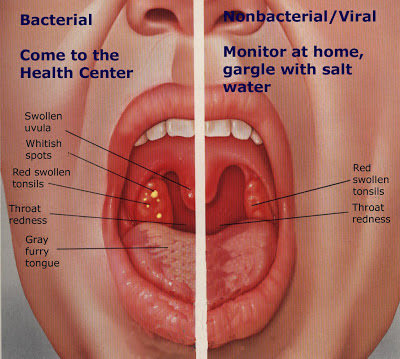 Word for the day: sore throat ~ NATIVE ENGLISH SPAIN