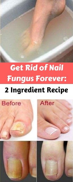 Get Rid of Nail Fungus Forever – 2 Ingredient Recipe