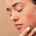 निशान , फुंसी, दाग, और धब्बे कैसे साफ़ करे | How to remove pimple 