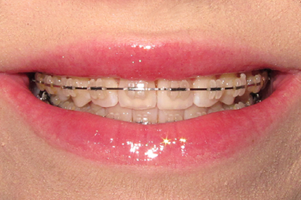 teeth braces. teeth braces before and after.
