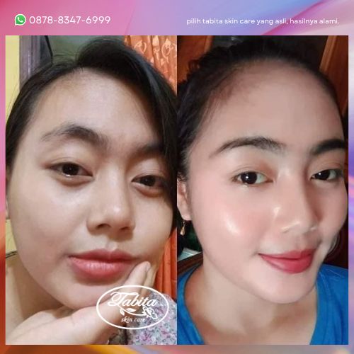 Perubahan Wajah Tabita Skin Care