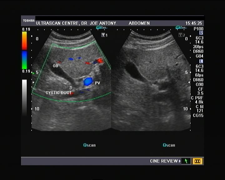 common bile duct cystic duct. with the common bile duct.