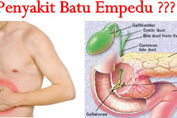 Penyebab dan Pengobatan Batu Empedu