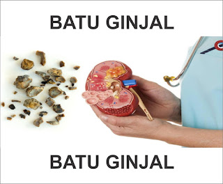 CARA MENGATASI PENYAKIT BATU GINJAL/KENCING BATU TANPA OPERASI