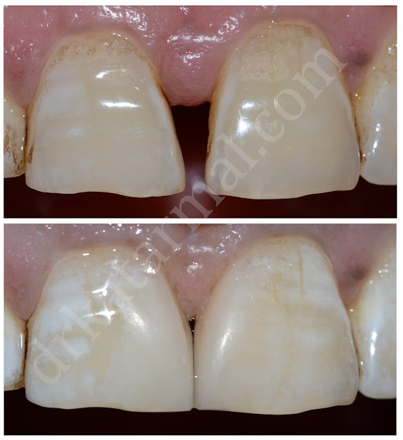 Midline space between teeth closed with composite filling