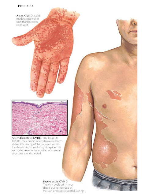 GRAFT VERSUS HOST DISEASE