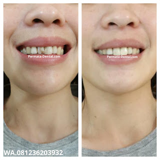 foto, gambar, gigi depan keropos Permata Dental Bali| sebelum dan sesudah gigi keropos diperbaiki di Permata Dental Bali | foto gigi keropos hitam Permata Dental Bali |gigi keropos karena sakit | gigi keropos berlubang | gigi keropos depan| gigi keropos bagian belakang | foto gigi keropos yang sudah diperbaiki Permata Dental Bali |  gigi keropos bagian depan| foto gigi keropos dan patah, foto gigi keropos oleh Permata Dental Bali, Bali Hits, Bali banget, area Bali, Bali kota, area kampus bali. veneer gigi keropos  Bali | veneer gigi keropos badung | veneer gigi keropos nusadua | veneer gigi keropos ngurahrai| veneer gigi keropos denpasar | veneer gigi kropos denpasar kota | veneer gigi keropos Bali | veneer gigi keropos gatsu | |veneer gigi keropos|  depan | veneer gigi keropos  atas | veneer gigi keropos  bawah | veneer gigi keropos  belakang |veneer gigi berlubang bali| veneer gigi berlubang Bali | veneer gigi berlubang nusadua| veneer gigi berlubang ngurahrai| veneer gigi berlubang Badung | veneer gigi berlubang depasar kota | veneer gigi berlubang denpasar| veneer gigi berlubang gatsu| veneer gigi berlubang jimbaran| veneer gigi berlubang bagus Permata Dental Bali | veneer gigi berlubang baik di Permata Dental Bali | veneer gigi berlubang cepat di Permata Dental Bali | veneer gigi berlubang murah di Permata Dental Bali | veneer gigi berlubang aman | veneer gigi berlubang mudah di Permata Dental Bali | veneer gigi berlubang promo Permata Dental Bali | gambar veneer gigi berlubang Permata Dental Bali | gambar sebelum dan sesudah veneer gigi hitam dan berlubang  veneer gigi hitam Bali | veneer gigi hitam Bali | veneer gigi hitam denpasar | veneer gigi hitam jimbaran | veneer gigi hitam nusadua | veneer gigi hitam Bali kota | veneer gigi hitam ngurahrai| veneer gigi hitam badung | veneer gigi hitam gatsu | veneer gigi hitam bagus | veneer gigi hitam baik | veneer gigi hitam cepat di Permata Dental Bali | veneer gigi hitam murah di Permata Dental Bali | veneer gigi hitam aman | veneer gigi hitam mudah di Permata Dental Bali | veneer gigi hitam promo Permata Dental Bali | gambar veneer gigi hitam Permata Dental Bali | gambar sebelum dan sesudah veneer gigi hitam dan berlubang Permata Dental