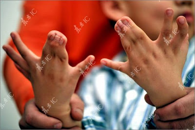 Boy with 31 Fingers and Toes Seen On www.coolpicturegallery.net