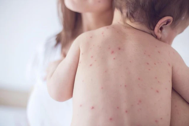 كيف تحمي طفلك من الجديري المائي؟ chickenpox