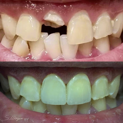 Ceramic Crowns