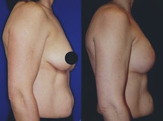 Breast surgery before and after | Before and after breast surgery