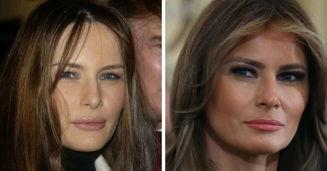 Melania Trump and Eyelid Surgery Rumors